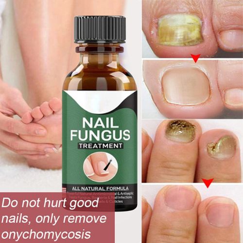 Nail  Buy 1 Get 1 FREE | Nail Fungus Treatment Serum 10ml