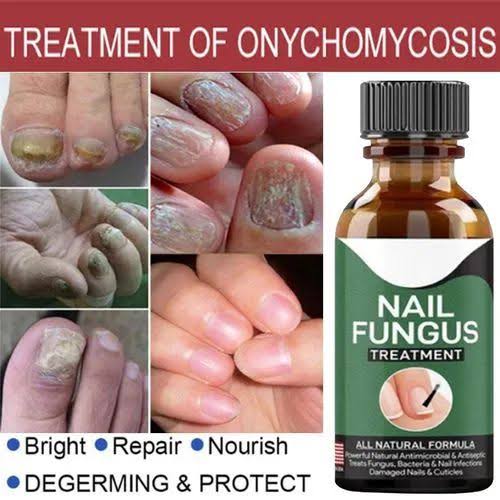 Nail  Buy 1 Get 1 FREE | Nail Fungus Treatment Serum 10ml